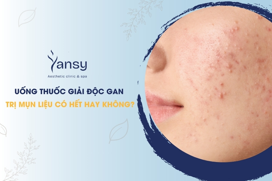 uống thuốc giải độc gan trị mụn