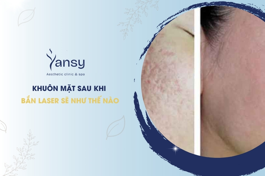 Khuôn mặt sau khi bắn laser sẽ như thế nào