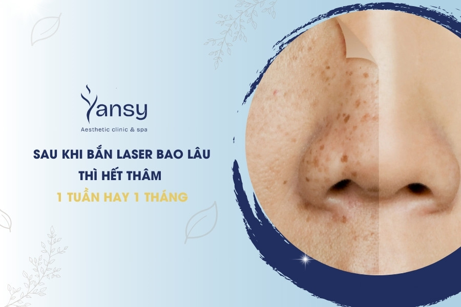 Sau khi bắn laser bao lâu thì hết thâm