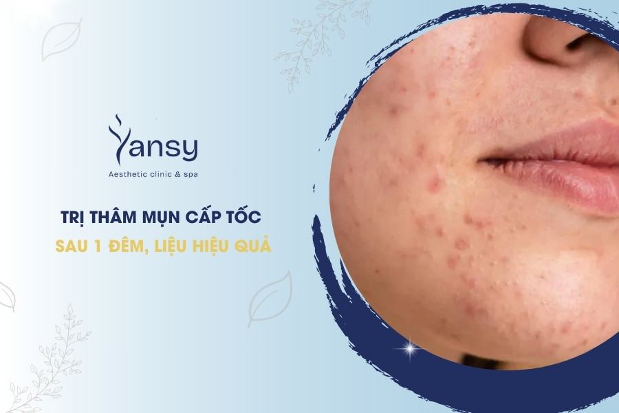Trị thâm mụn cấp tốc sau 1 đêm, liệu hiệu quả