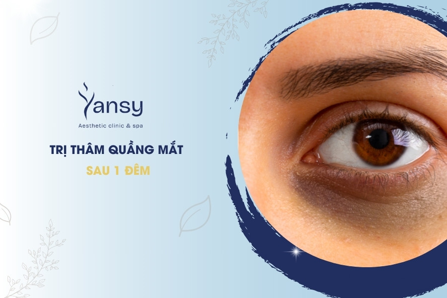 Trị thâm quầng mắt sau 1 đêm