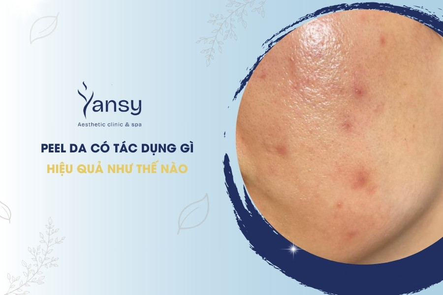 Peel da có tác dụng gì hiệu quả như thế nào