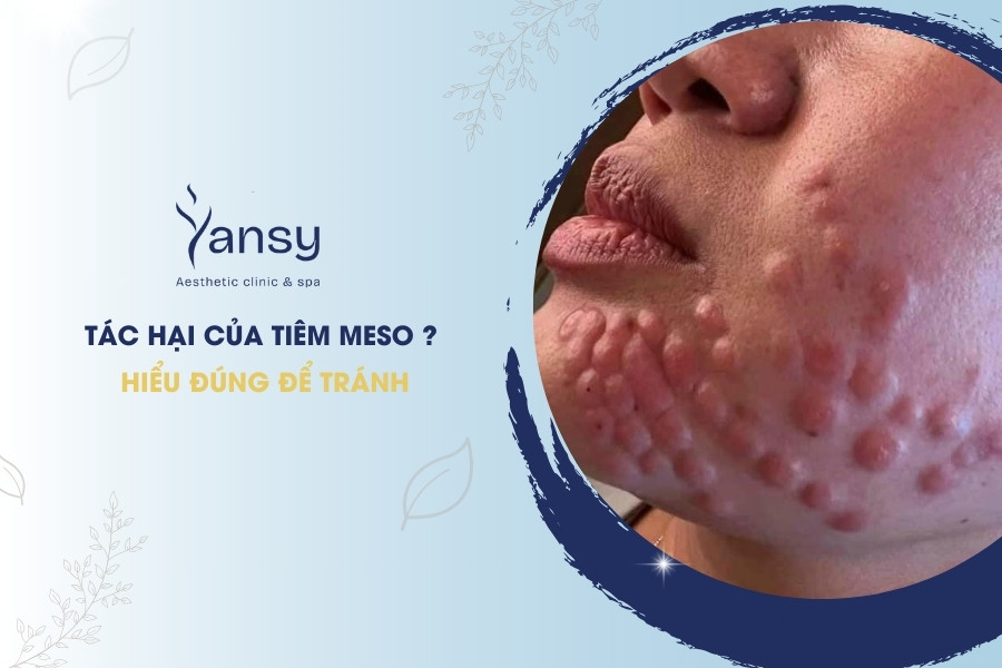 Tác hại của tiêm meso ? Hiểu đúng để tránh